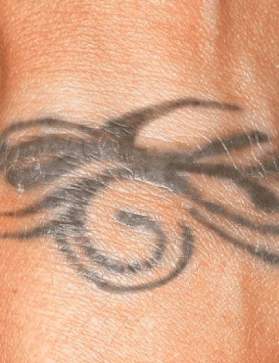 Eliminación de tatuaje con láser en Granada, caso 2: antes