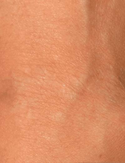 Eliminación de tatuaje con láser en Granada, caso 2: después