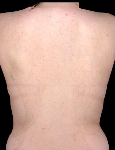 Eliminación de tatuaje con láser en Granada, caso 3: después