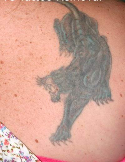 Eliminación de tatuaje con láser en Granada, caso 4: antes