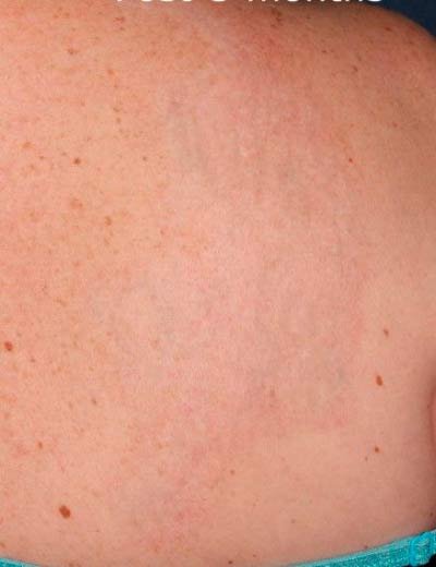 Eliminación de tatuaje con láser en Granada, caso 4: después