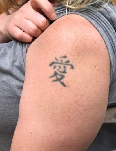 Eliminación de tatuaje con láser en Granada, caso 5: antes