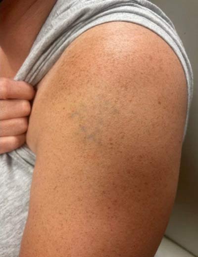 Eliminación de tatuaje con láser en Granada, caso 5: después