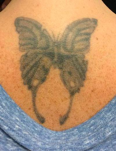 Eliminación de tatuaje con láser en Granada, caso 6: antes
