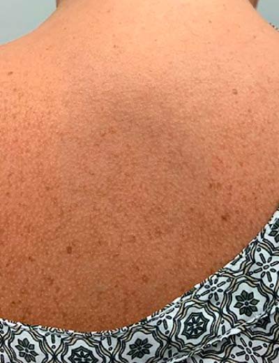 Eliminación de tatuaje con láser en Granada, caso 6: después