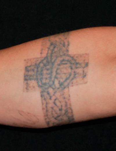 Eliminación de tatuaje con láser en Granada, caso 7: antes