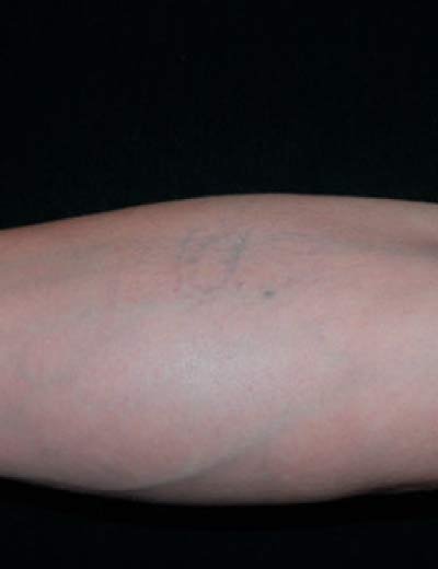 Eliminación de tatuaje con láser en Granada, caso 7: después