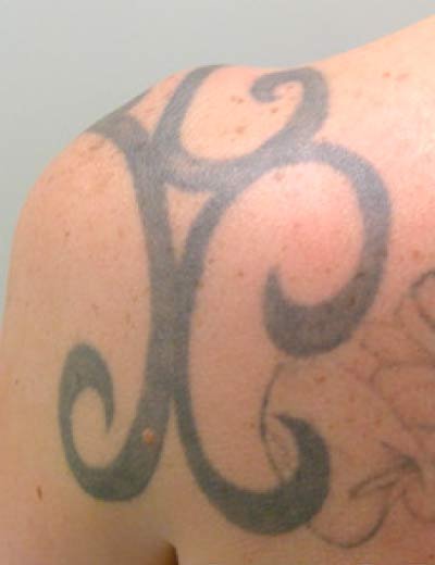 Eliminación de tatuaje con láser en Granada, caso 8: antes