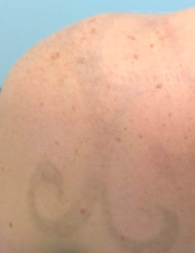 Eliminación de tatuaje con láser en Granada, caso 8: después