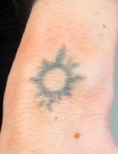 Eliminación de tatuaje con láser en Granada, caso 9: antes