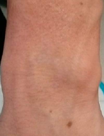 Eliminación de tatuaje con láser en Granada, caso 9: después
